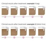 ⁦מסיר שיער Philips SC1997/00 פיליפס⁩ – תמונה ⁦4⁩